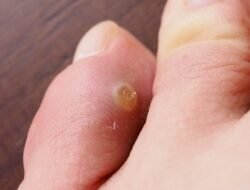 Susah Hilangkan Mata Ikan di Kaki? Yuk Ikuti Cara ini Dijamin Hilang!