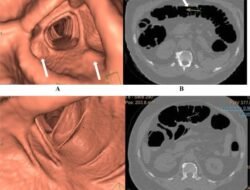 Mengenal, Virtual Colonoscopy Alternatif Cepat dan Nyaman Skrining Kanker Usus