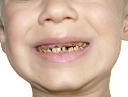 Wajib Tahu! Makanan dan Minuman yang Bikin Gigi Rusak