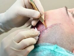 Jangan Asal! Kelompok Ini Tidak Boleh Transplantasi Rambut Loh