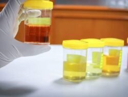 Deretan Penyakit yang Gejalanya Bisa Diketahui dari Warna Urine