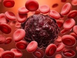 Waduh! Penderita Kanker Darah di RI Meningkat, Mayoritas Idap Leukemia